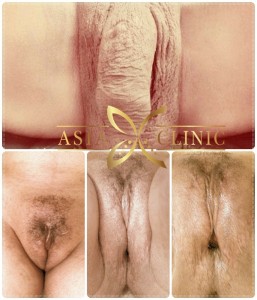 After Sex Change Vagina - PORNO XXX Photos