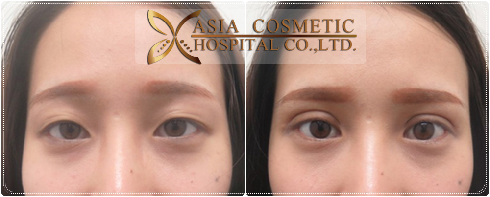 double eyelid surgery thailand