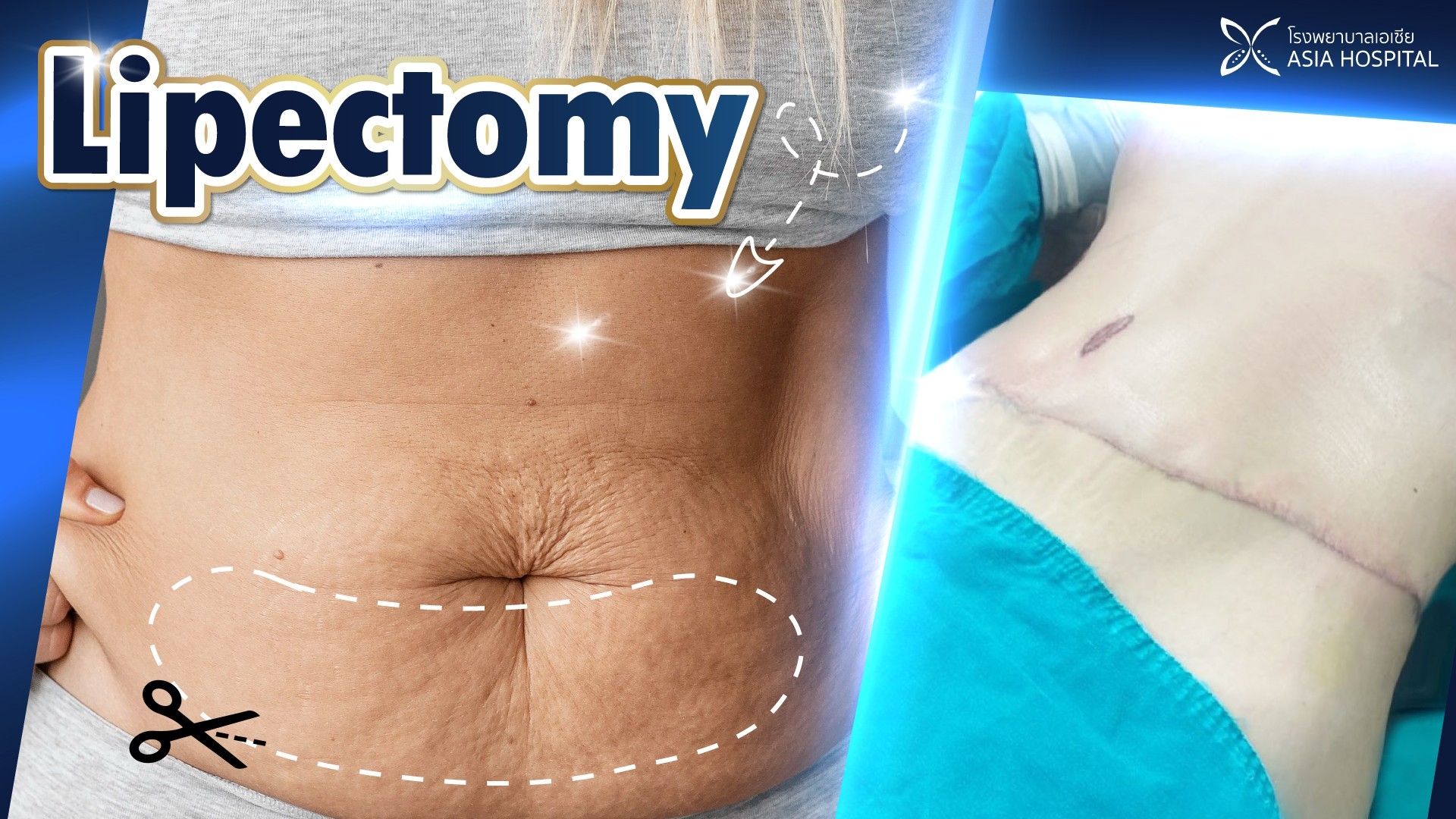https://www.asiacosmeticthailand.com/wp-content/uploads/2023/03/lipectomy-thailand.jpg